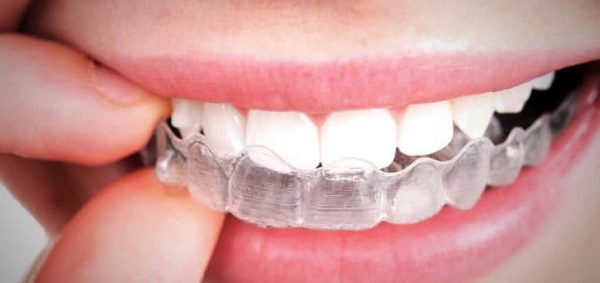 Капи для вирівнювання зубів майже непомітні на зубах