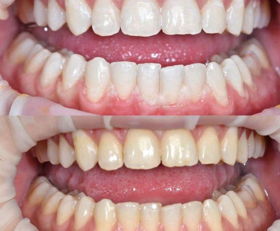 Відбілювання зубів, скільки коштує відбілити зуби в стоматолога, відбілювання зубів в стоматології